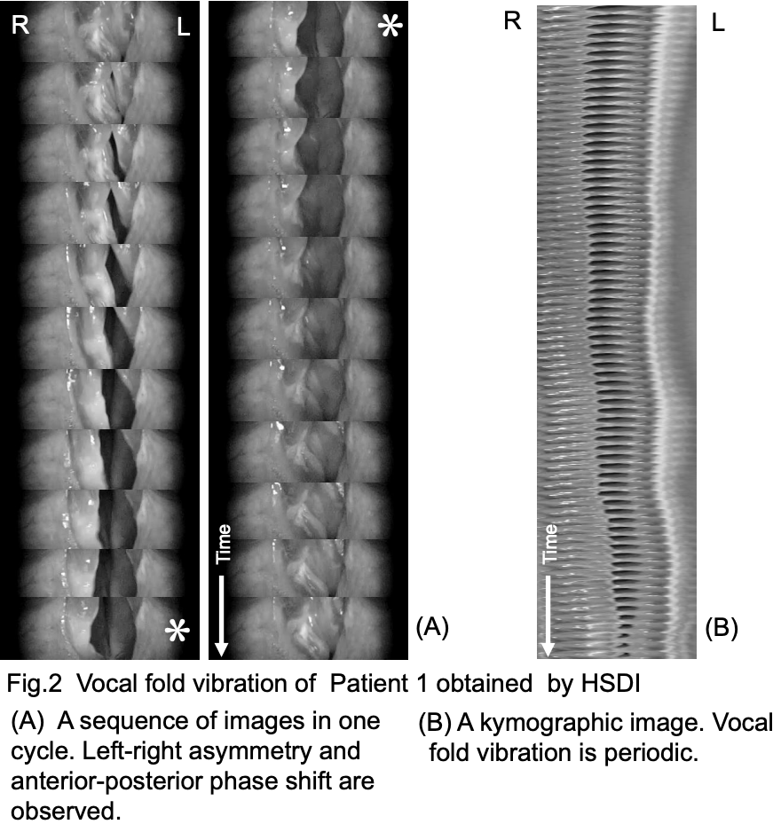 高速度デジタル撮影で観察したラインケ浮腫患者の声帯振動 - huuchiの音楽論文案内