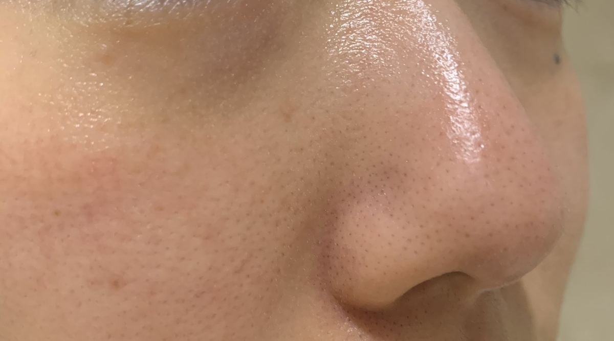 エンビロン Aブースト1でいちご鼻改善 3種のビタミンa 目指せ毛穴レス いちご鼻と戦うちゃんの奮闘ブログ