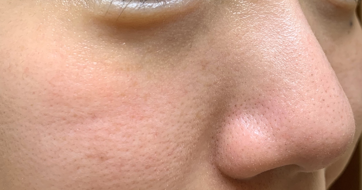 黒ずみ毛穴は影と産毛が原因 角栓詰まりとの違いを撮り比べてみました 目指せ毛穴レス いちご鼻と戦うちゃんの奮闘ブログ