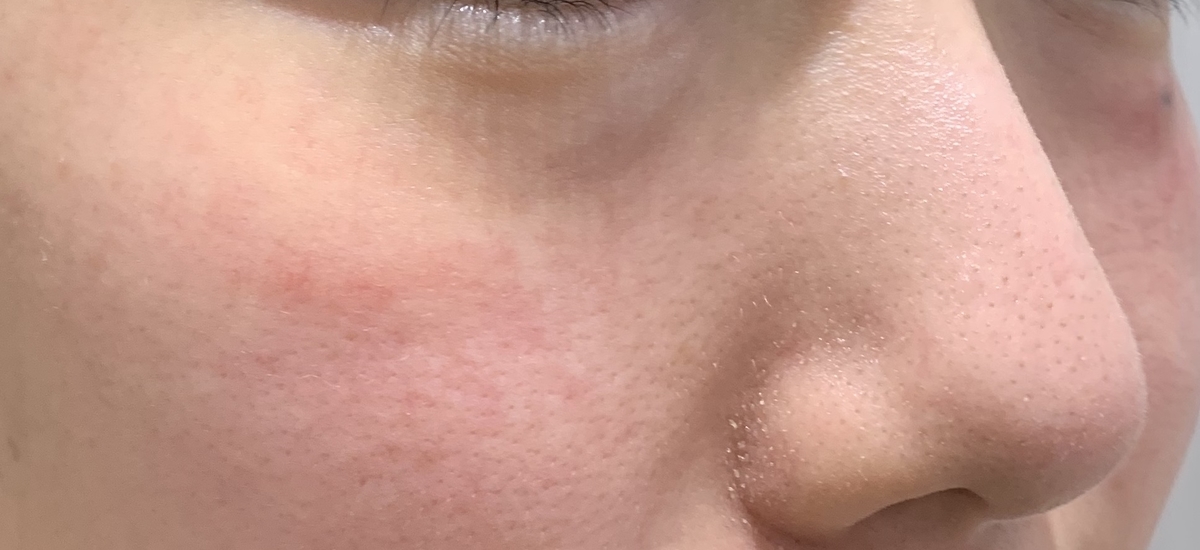 レーザートーニングで産毛を処理しました 目指せ毛穴レス いちご鼻と戦うちゃんの奮闘ブログ