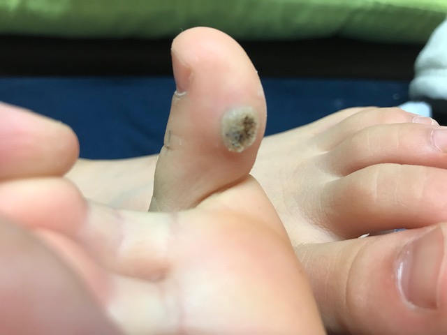 子供の足の指にできたイボの治療経過 治療４ ５回目 いつか咲く日が来るでしょう