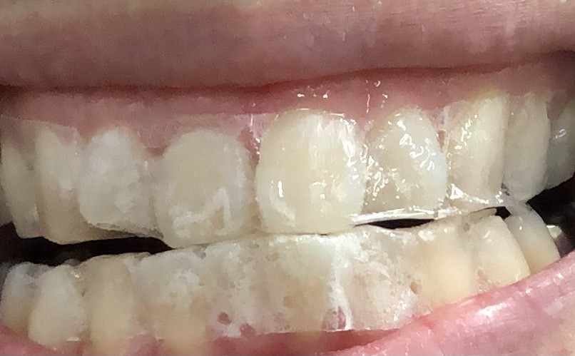 Crest 3D White Whitestrips 1HOUR EXPRESS クレスト失敗例