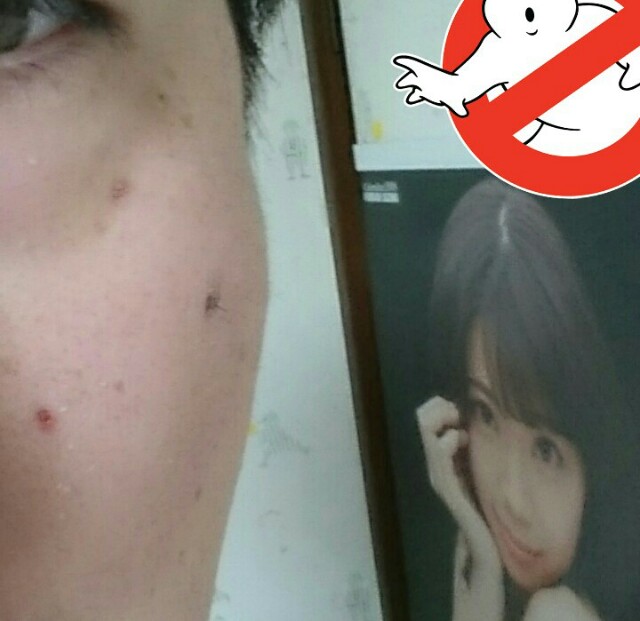 ホクロにレーザーを照射して1週間経過