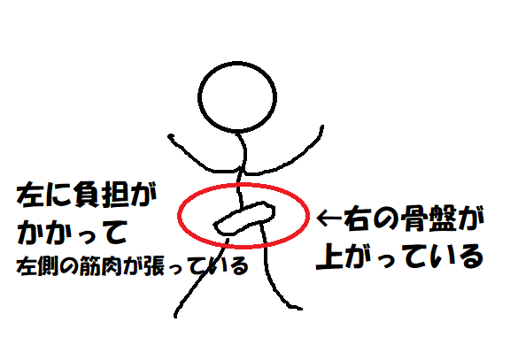 骨盤調整