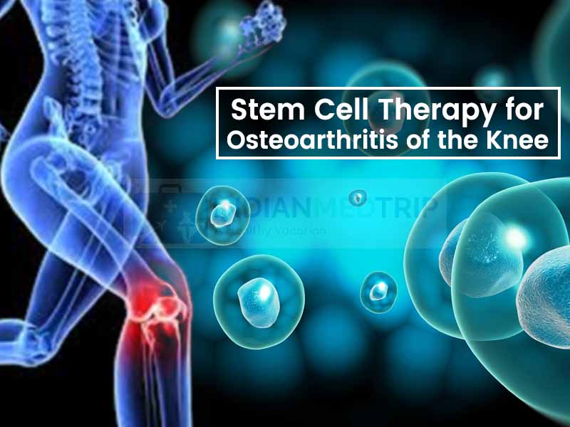 Stem Cell Therapy for Osteoarthritis of the Knee - indianmedtrip’s blog
