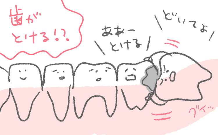 親知らず抜歯レポ 放置したら歯が溶ける 子育て中で忙しいけど抜くなら今だ ははとこと 自由な男子とママと時々パパの育児漫画 イラストレーターにいどゆうの子育てブログ