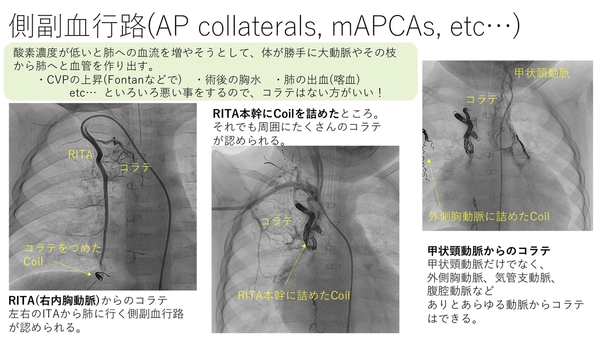 小児のカテーテル検査について 造影 その3 基本22 誰でもわかる先天性心疾患