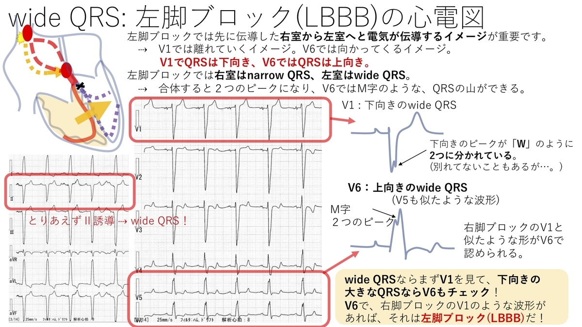 不整脈 Wide Qrs 右脚ブロック Rbbb 左脚ブロック Lbbb について 基本27 誰でもわかる先天性心疾患