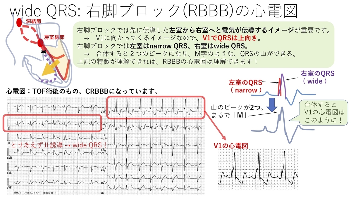 不整脈 Wide Qrs 右脚ブロック Rbbb 左脚ブロック Lbbb について 基本27 誰でもわかる先天性心疾患