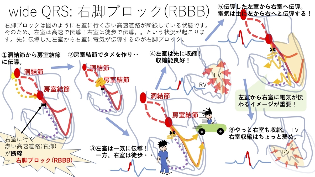不整脈 Wide Qrs 右脚ブロック Rbbb 左脚ブロック Lbbb について 基本27 誰でもわかる先天性心疾患
