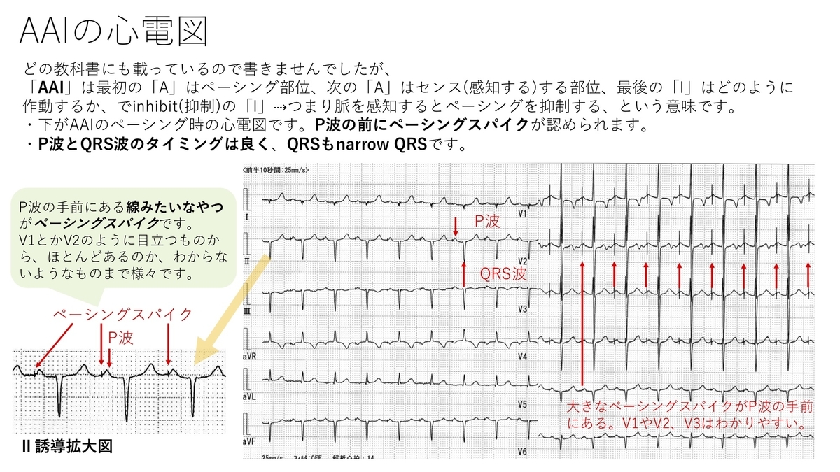 不整脈：ペースメーカーについて その2 ；AAIとrate response(レートレスポンス)機能について 〜基本34〜 - 誰でもわかる ...