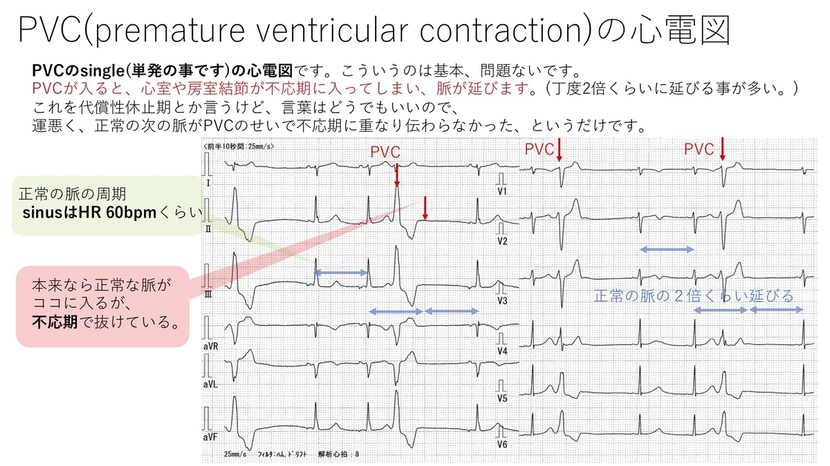 不整脈：心室性期外収縮(PVC)について 〜基本42〜 - 誰でもわかる先天性心疾患