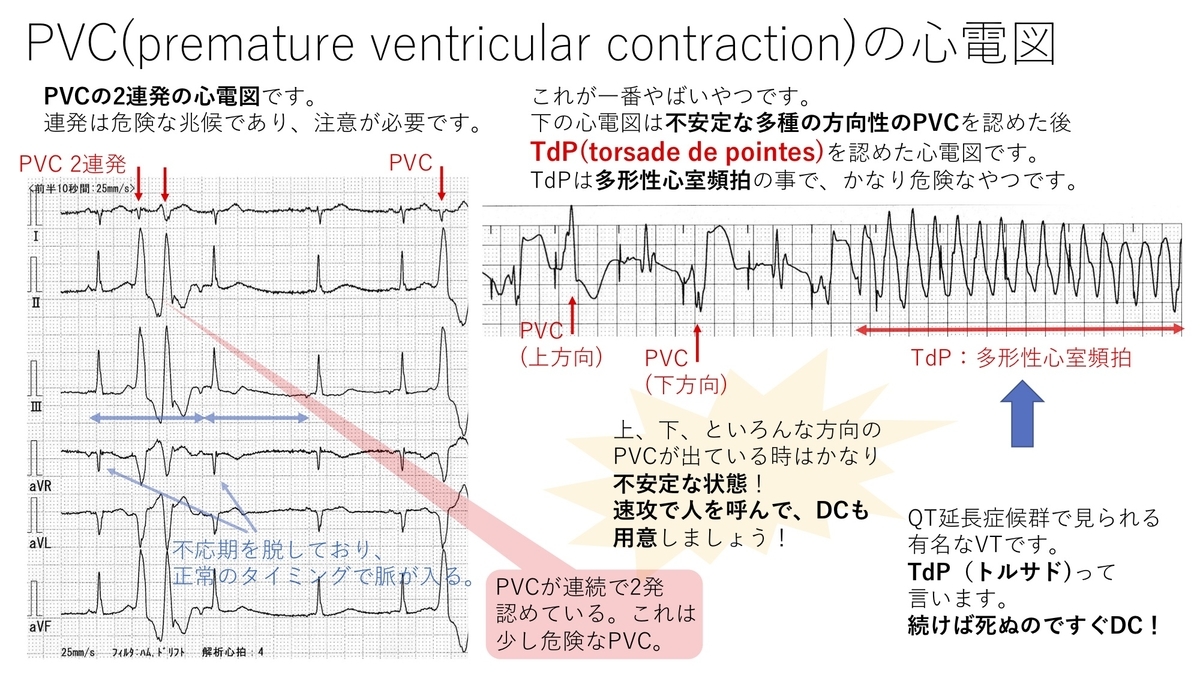 不整脈：心室性期外収縮(PVC)について 〜基本42〜 - 誰でもわかる先天性心疾患