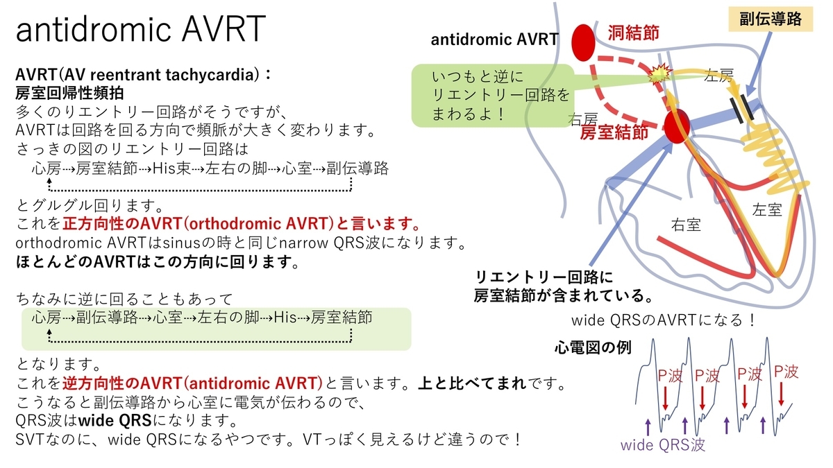 不整脈：上室性頻脈(SVT) AVRT(房室回帰性頻拍)について 〜基本45〜 - 誰でもわかる先天性心疾患