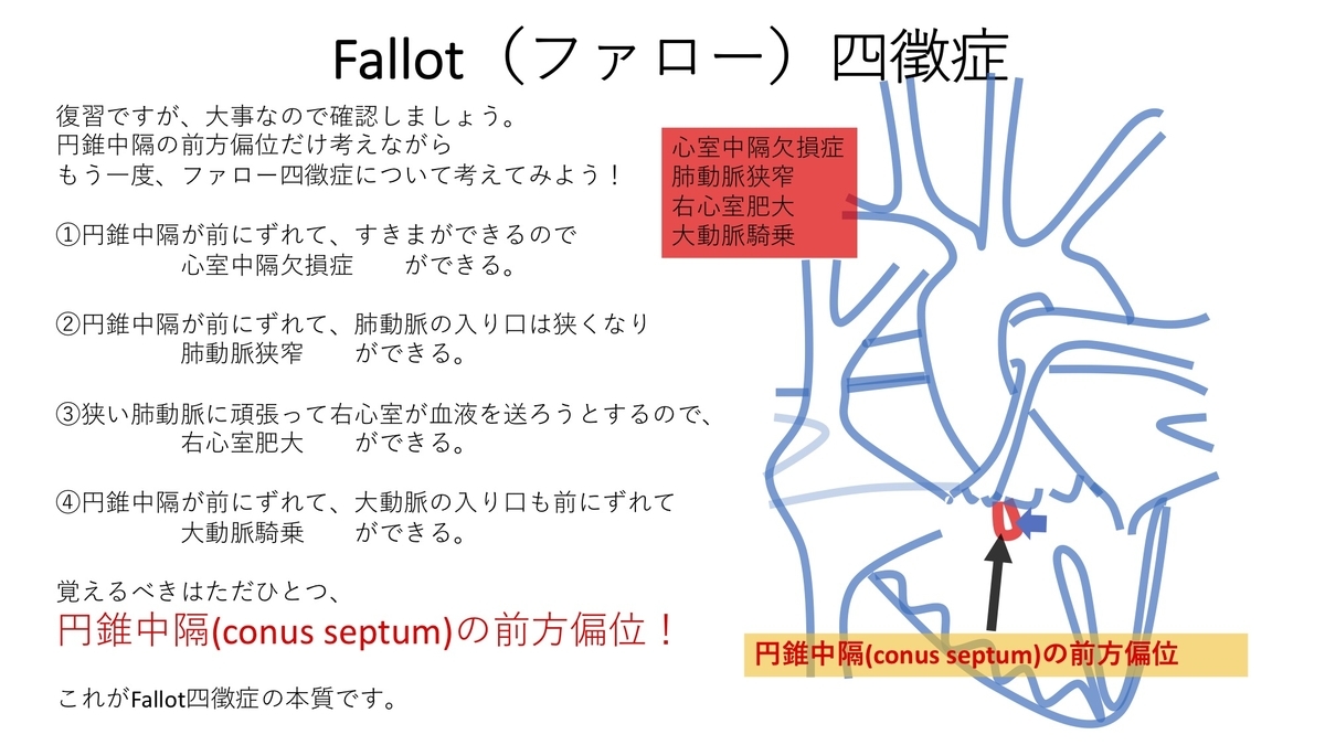 ファロー四徴症 Tof Tetralogy Of Fallot について 円錐中隔の前方偏位 疾患6 誰でもわかる先天性心疾患