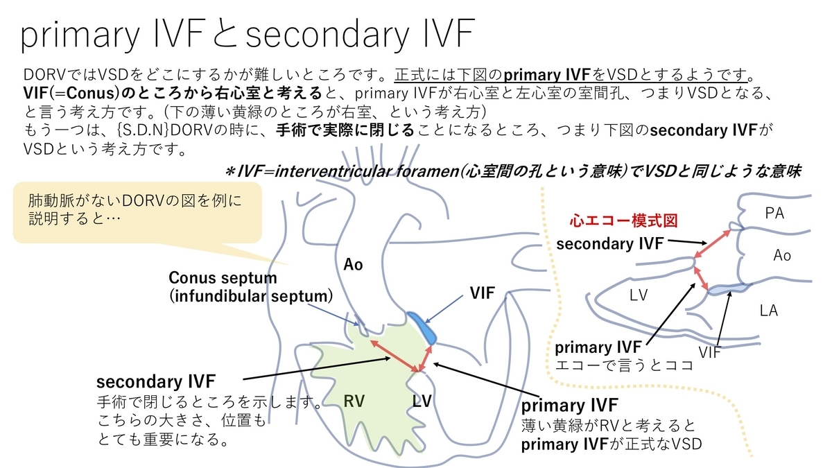 Dorv 両大血管右室起始症 その5 S D N Dorv Fallot Type Primary Ivfとsecondary Ivfについて 疾患40 誰でもわかる先天性心疾患