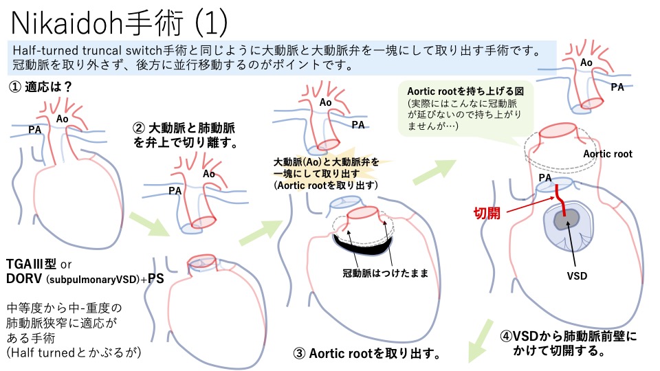 DORV(両大血管右室起始症) その7 Posterior TGAやfalse Taussig