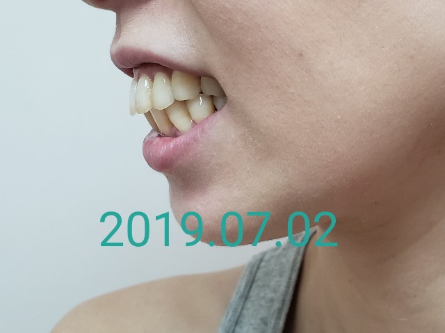 f:id:invisalignkao:20190903174328j:plain