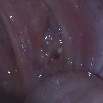 口臭の原因 膿栓 臭い玉 の取り方 自力で取る方法7通りを比較 鼻うがい 綿棒 シリンジetc Jakotan S Blog