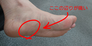 土踏まずを押すと痛い 足裏が痛い 足底腱膜炎の治療体験記 てくてくチャンネル