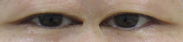 眼瞼下垂保険適用手術の手術代は 術後4ヶ月までの経過写真まとめ ていないブログ