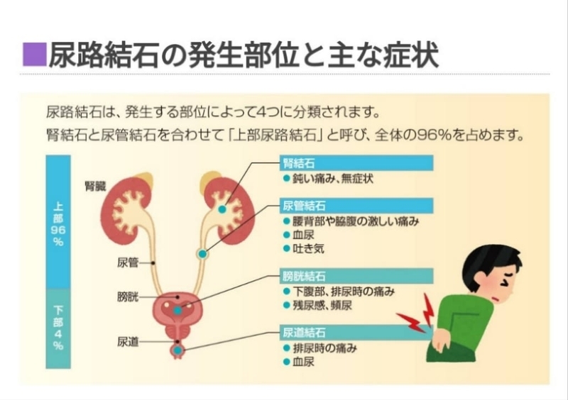 尿管結石なう ️お腹の激痛に？ - jt7k4njz’s blog