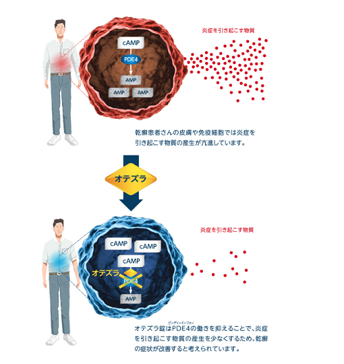オテズラ錠はなぜ乾癬改善に期待できるのか?