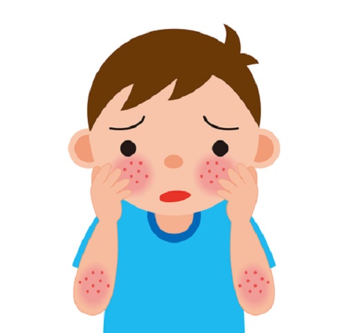 乾癬を発症してしまったらどうしたらいいの?