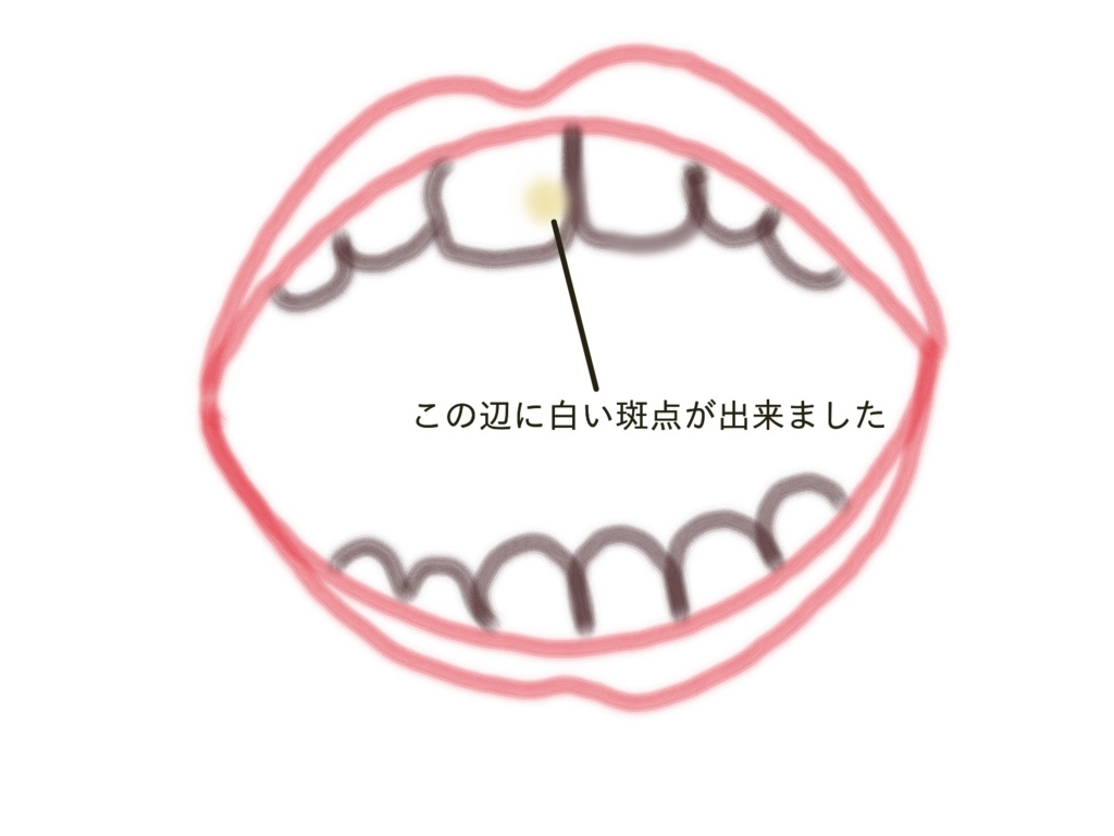 長女２歳０カ月 やっぱり虫歯だった 主婦のわたくしごと