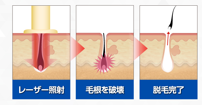 毛抜きで毛根が死ぬ 残念だけどそれはあり得ないって話 脇毛が濃いし太い時の処理方法 対処や対策のまとめ