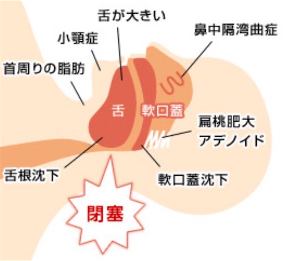 f:id:ketoraaa:20180902114701j:image