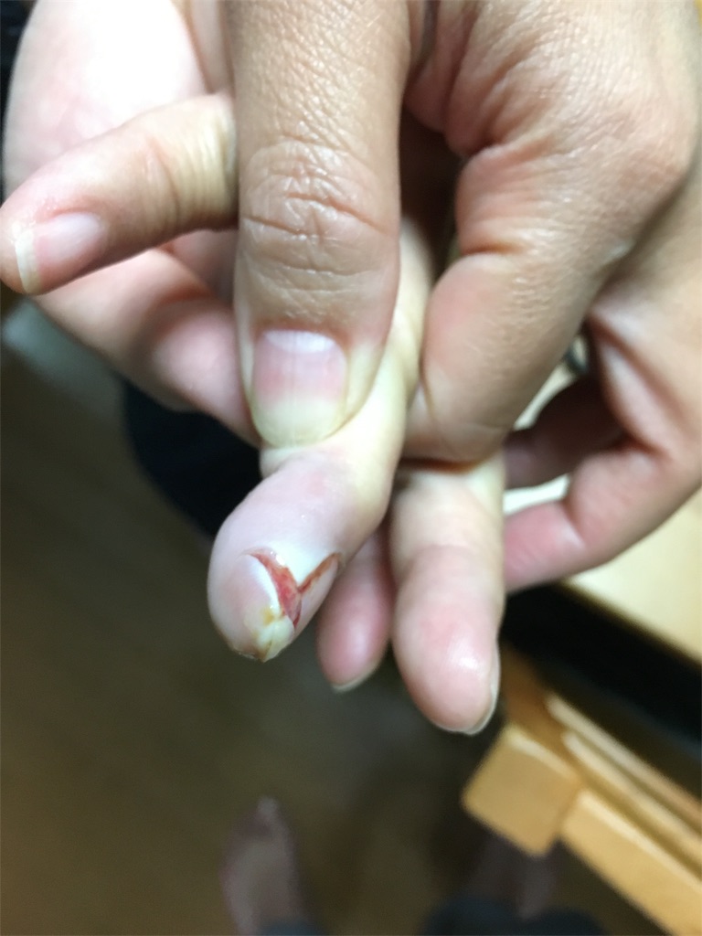 スライサーで指先をざっくり切った 湿潤療法にて手当してみた 3母日記