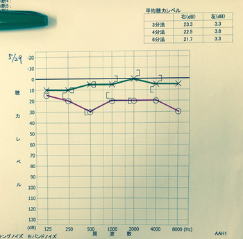 20170529聴力検査