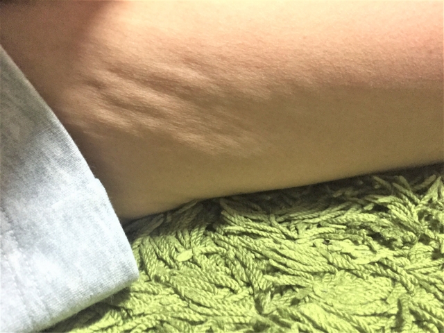 やせたら皮膚がたるんでしまった 引き締めるなら対策はコレ やせたら皮膚がたるんでしまった 引き締めるなら対策はコレ