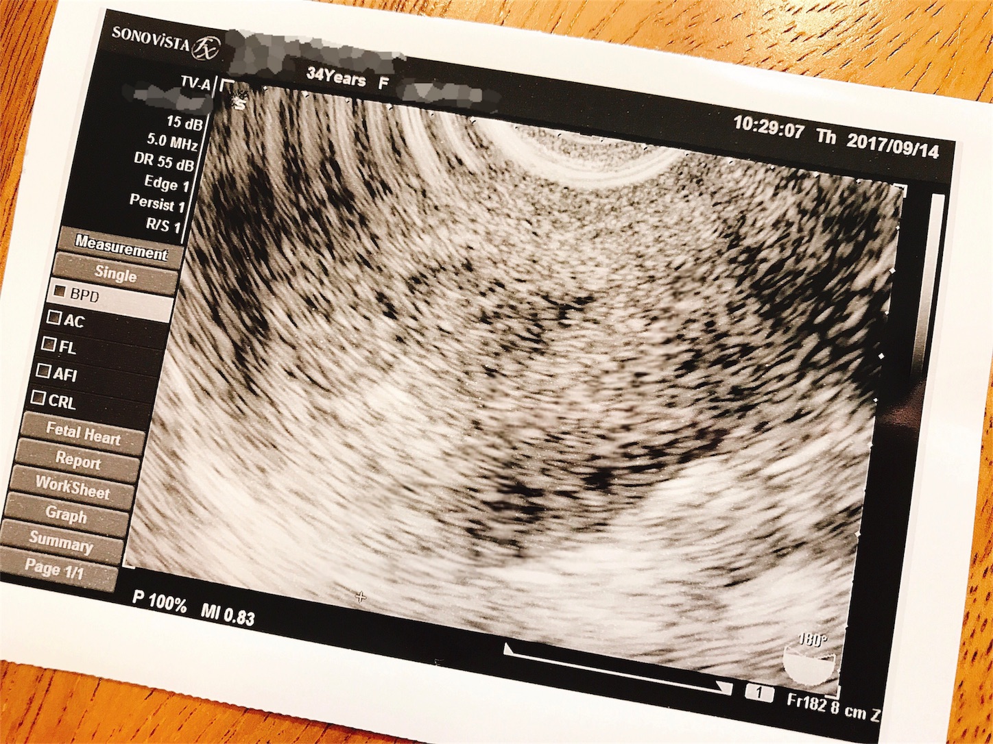 5w1d 胎嚢まだ見えない 笑顔に勝る化粧なし