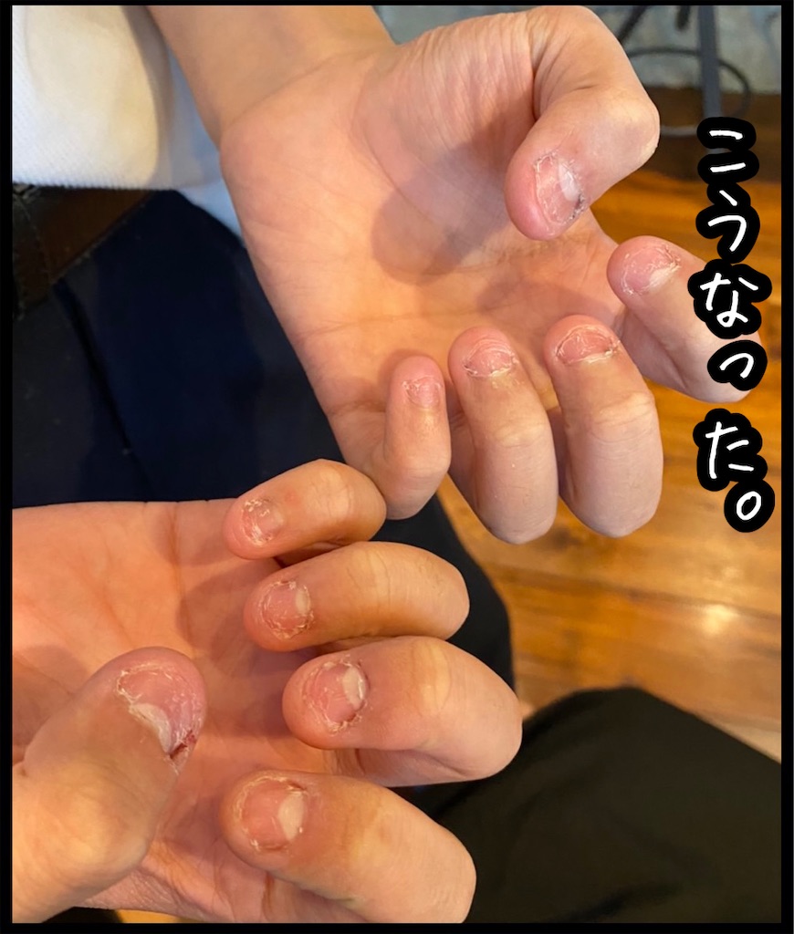 男子小学生 爪噛み ブログ 