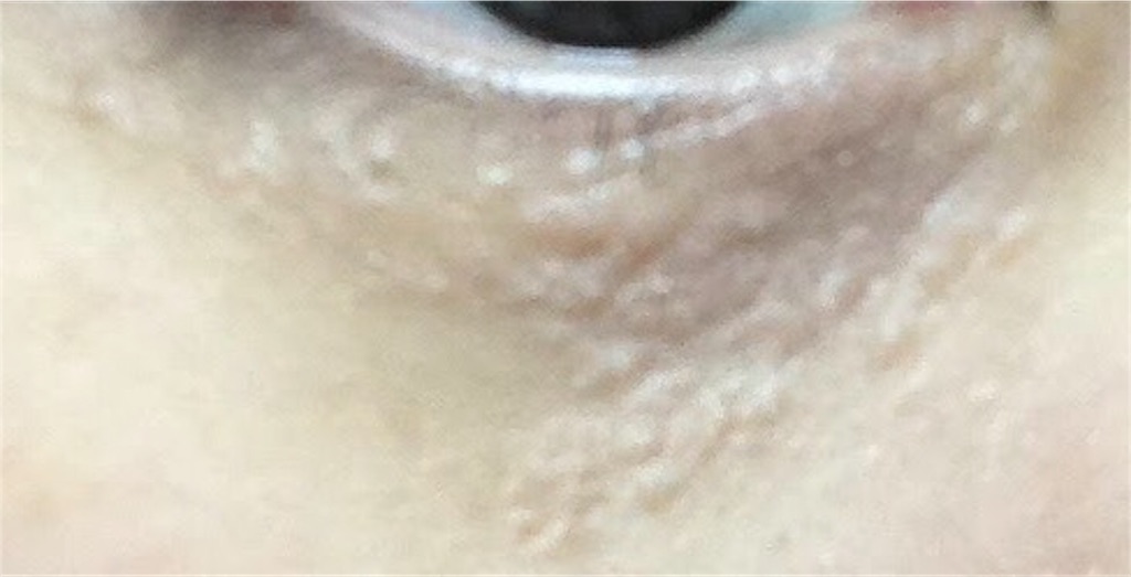 4 炭酸レーザーで汗管腫を焼いてきたよ 北大路どおり 4 炭酸レーザーで汗管腫を焼いてきたよ 北大路どおり