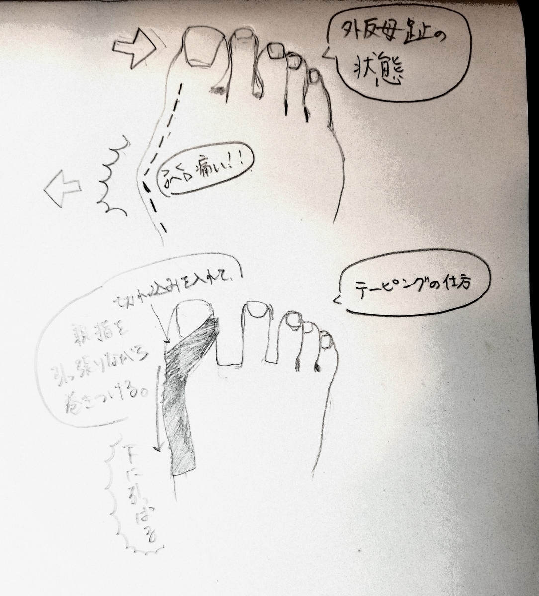 外反母趾 ズキズキ