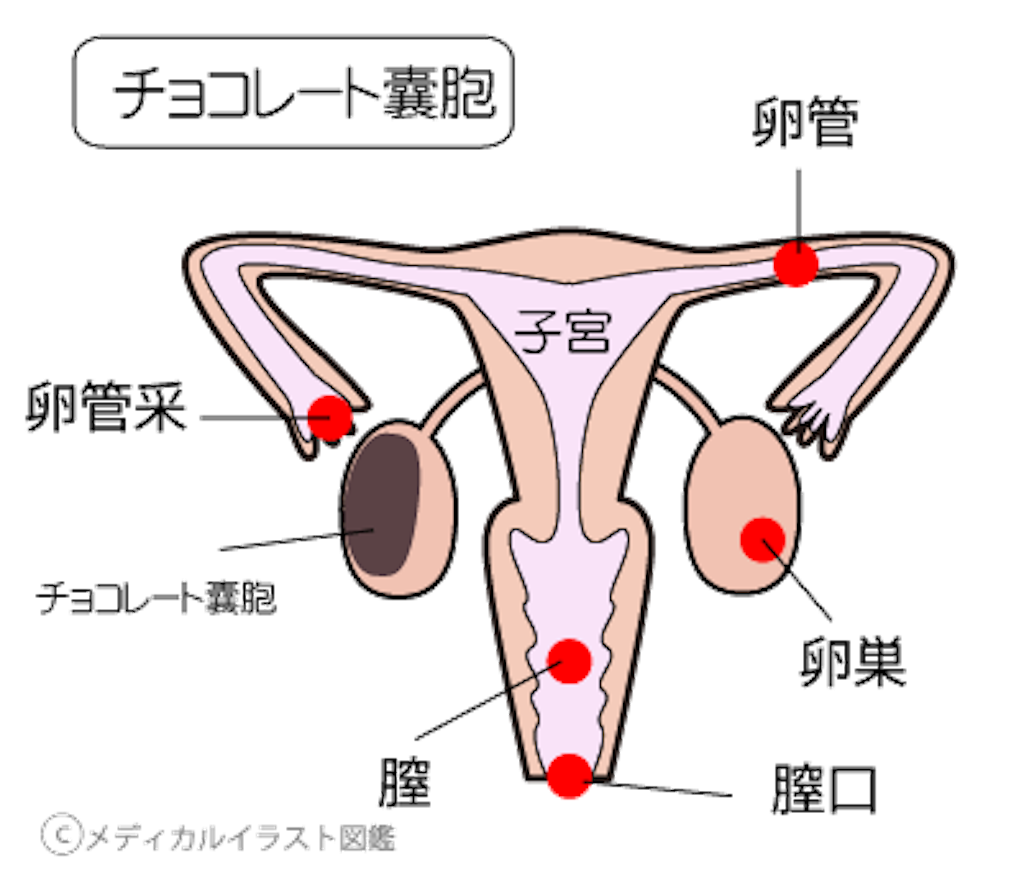 子宮をプルプルへ チョコレート嚢胞を子宮力アップで撃退プロジェクト 漢方のチカラで幸せファミリーを生み出すサロン Paeon ぺオン 子宮をプルプルへ チョコレート嚢胞を子宮力アップで撃退プロジェクト 漢方のチカラで幸せファミリーを生み出すサロン Paeon ぺオン
