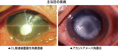 現役医学部生が教える コンタクトを正しく使ってないとそんな病気に ことぶきブログ