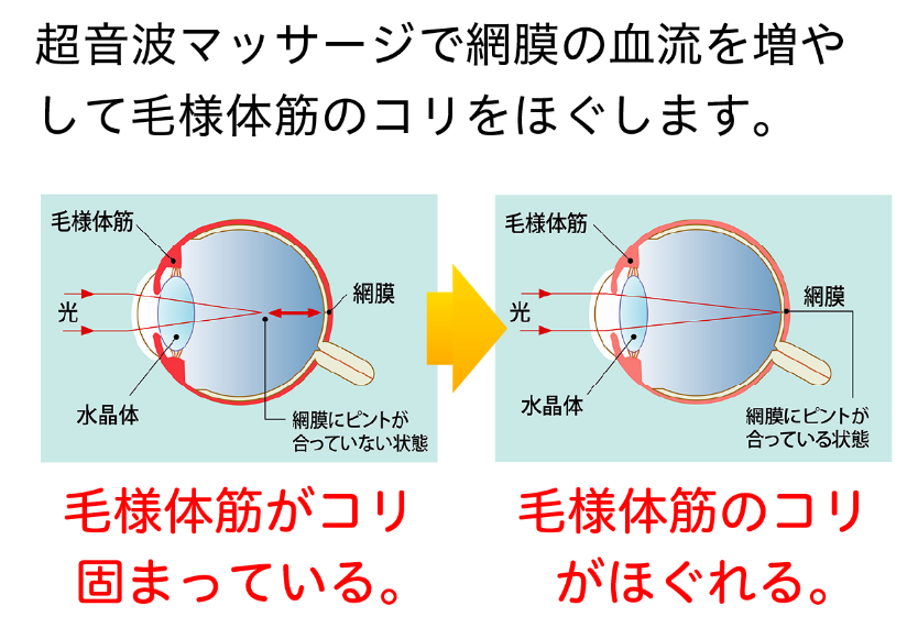 超音波で視力回復