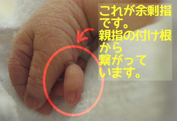 多指症で生まれた息子の話 画像あり きゃとらばのどうしようもないブログ 男子の育児