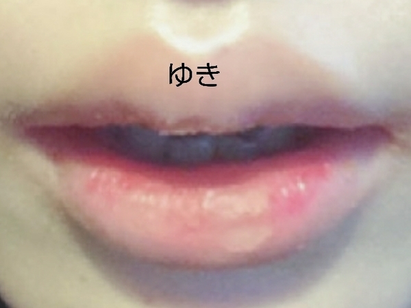 私の剥脱性口唇炎の症状詳細 発症から完治まで ユキコク