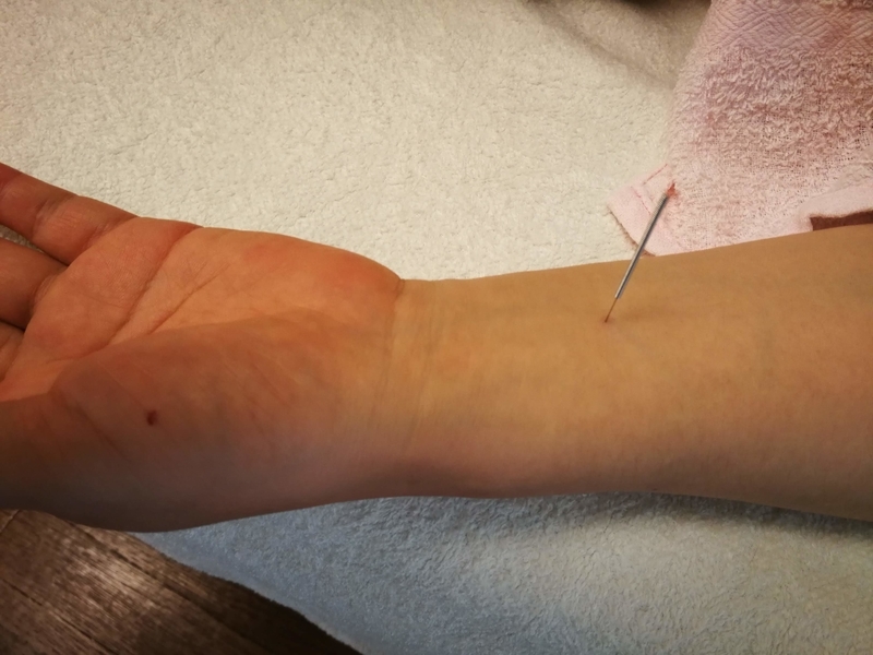内関（ないかん）に刺した鍼