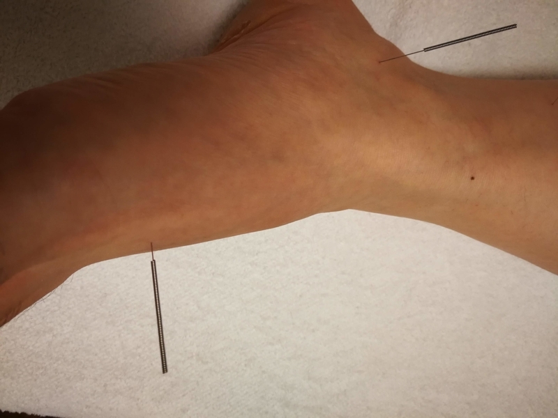 太衝と照海に刺した鍼
