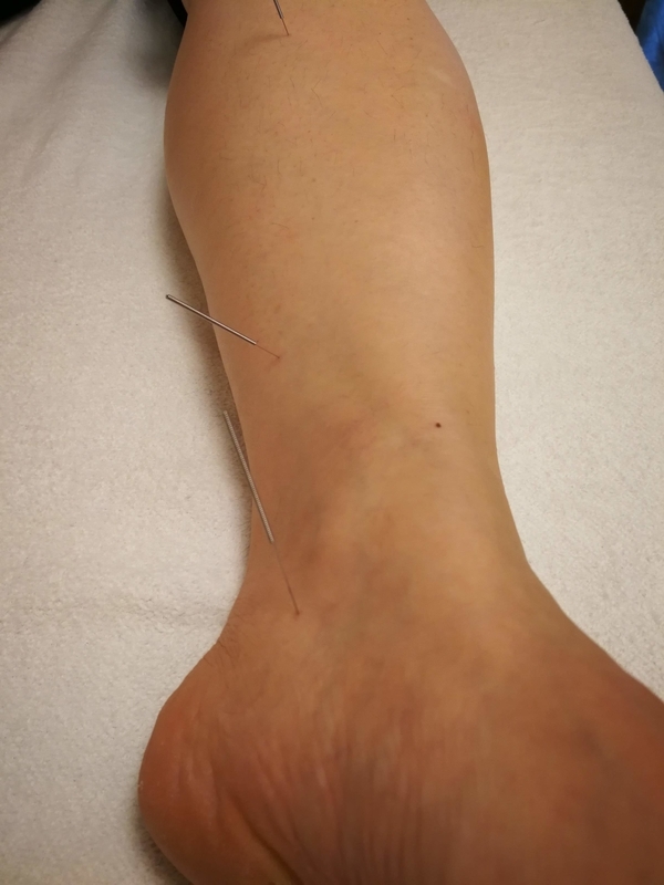 照海（しょうかい）に刺した鍼