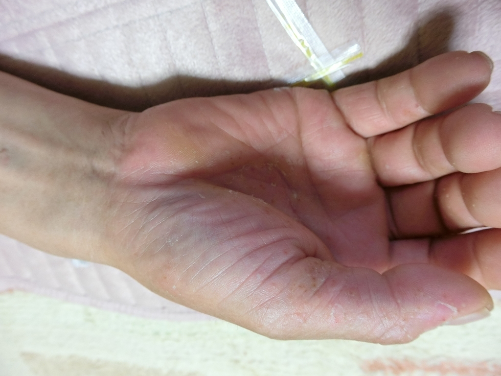 手のひらの皮が剥けている