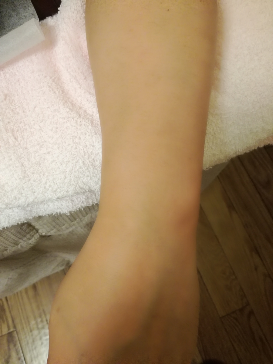 鍼をする前の左手