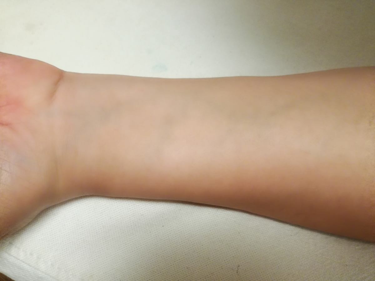 前腕の内側に青色の血管が見えてきた。