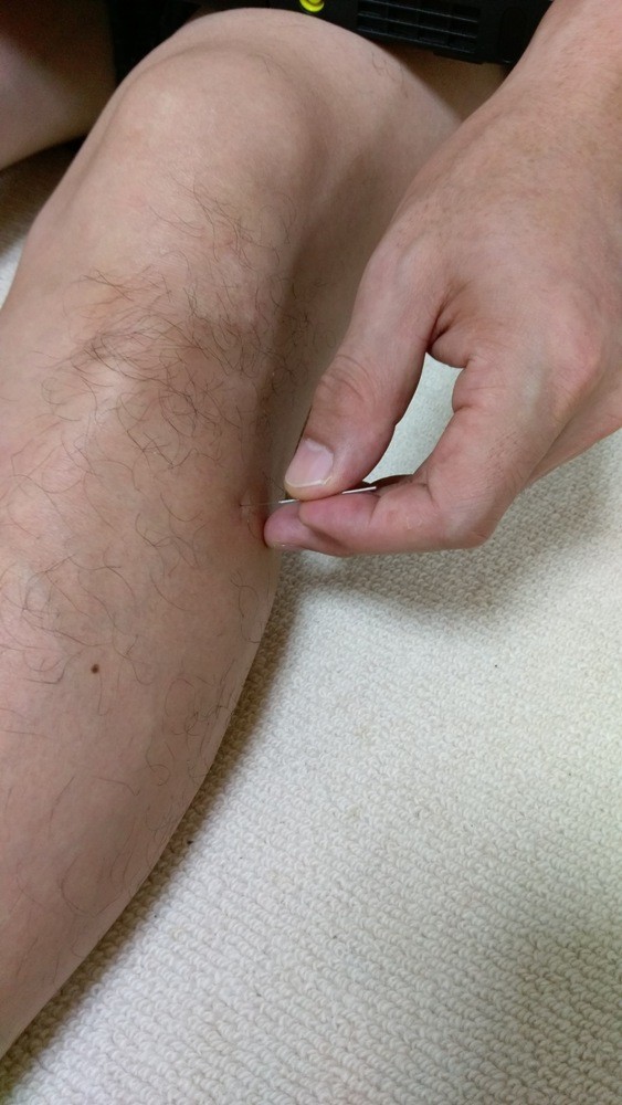 わき腹が痛いのは、陽陵泉一つで治せる